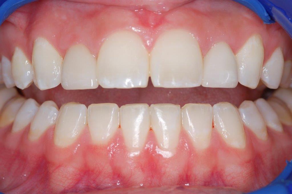 Case 13: after dental treatment