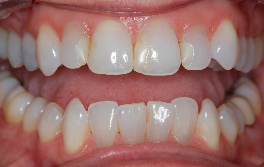Case 11: before dental treatment