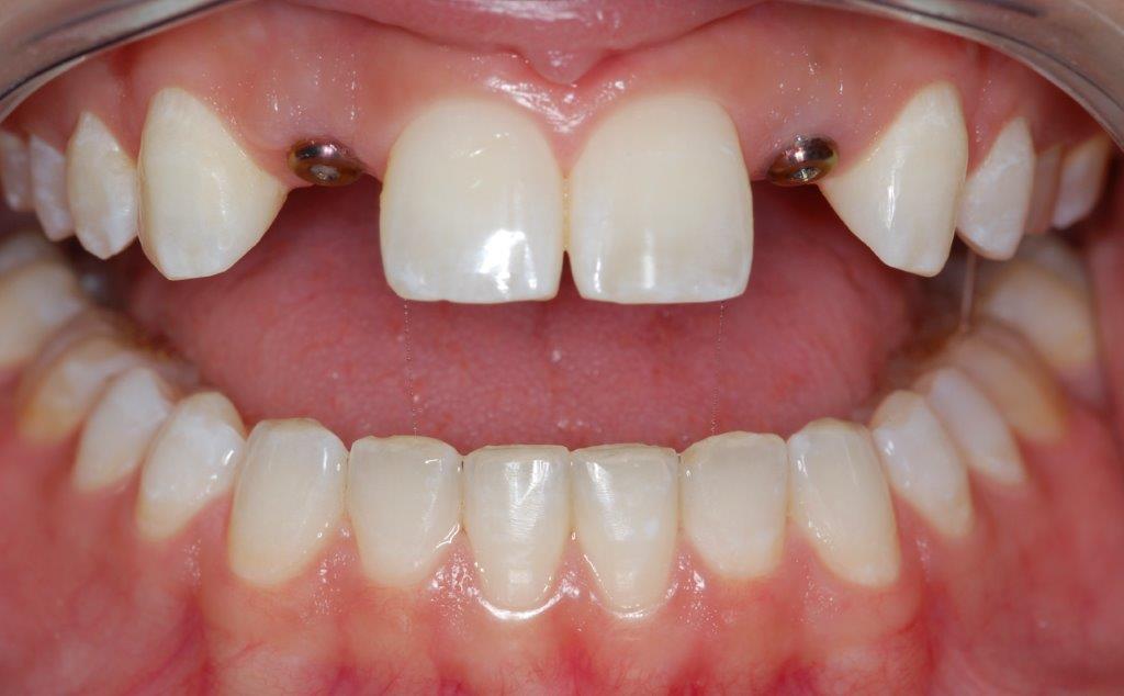 Case 13: before dental treatment